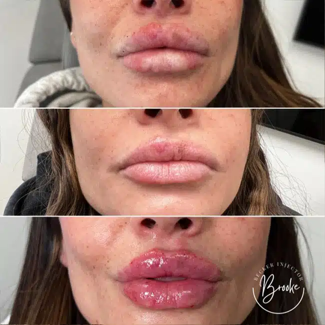 Before & After Photos Brooke Carrero, RN