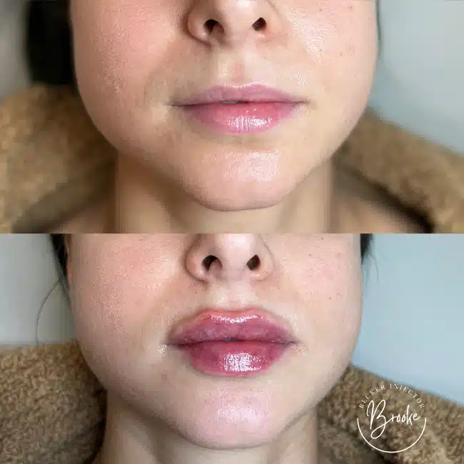 Before & After Photos Brooke Carrero, RN