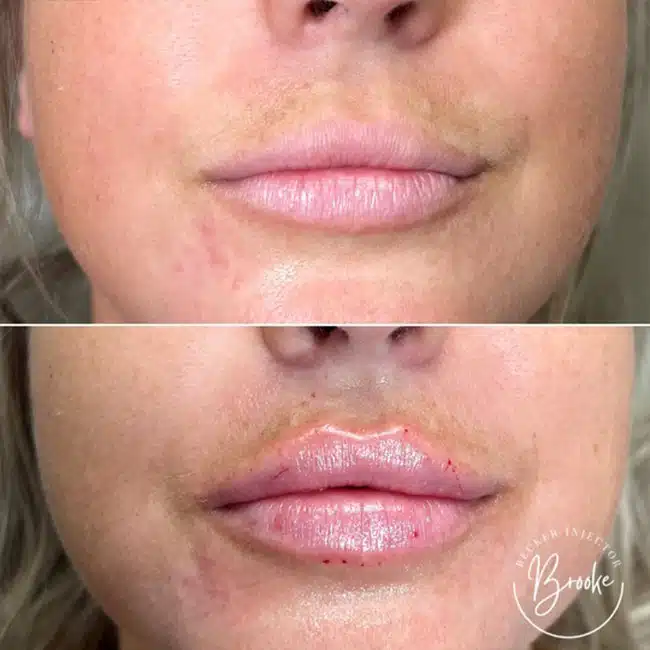 Before & After Photos Brooke Carrero, RN