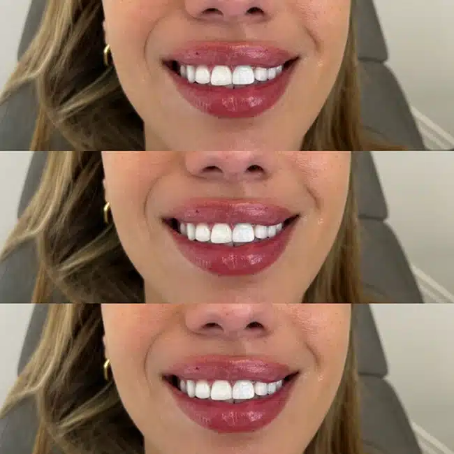 Before & After Photos Brooke Carrero, RN