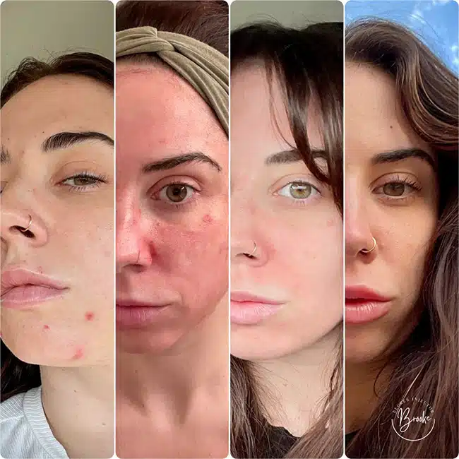 Before & After Photos Brooke Carrero, RN