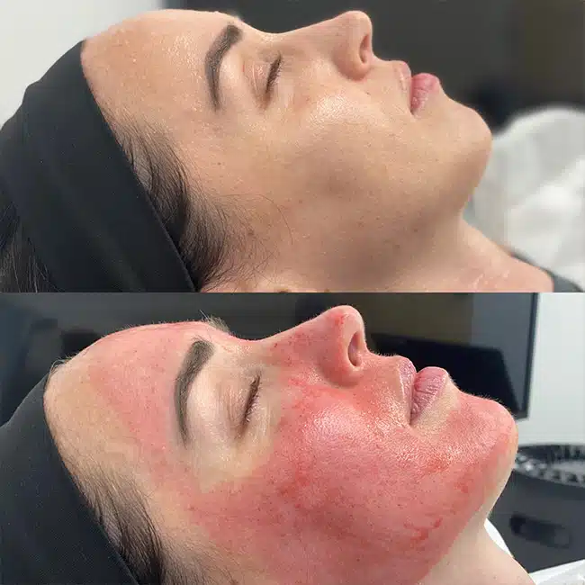 Before & After Photos Brooke Carrero, RN