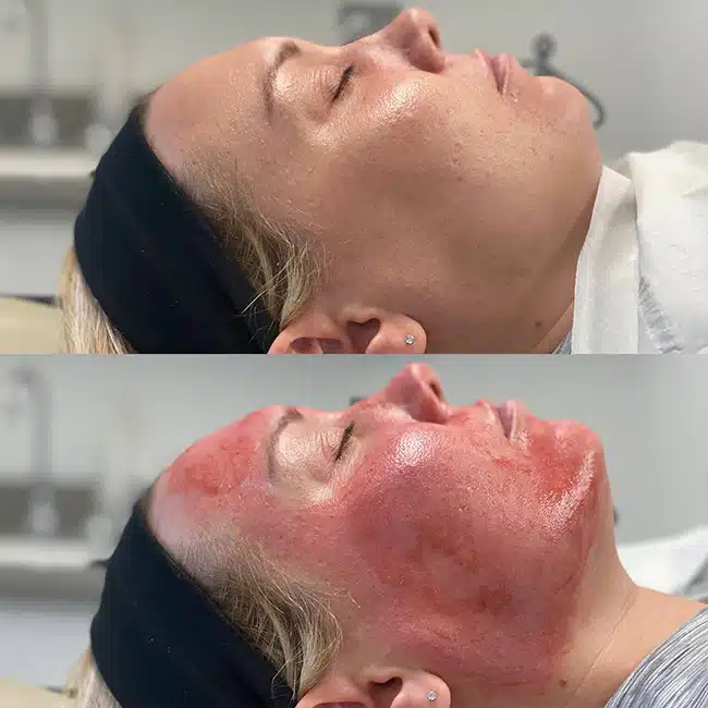 Before & After Photos Brooke Carrero, RN