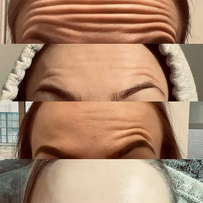 Before & After Photos Brooke Carrero, RN