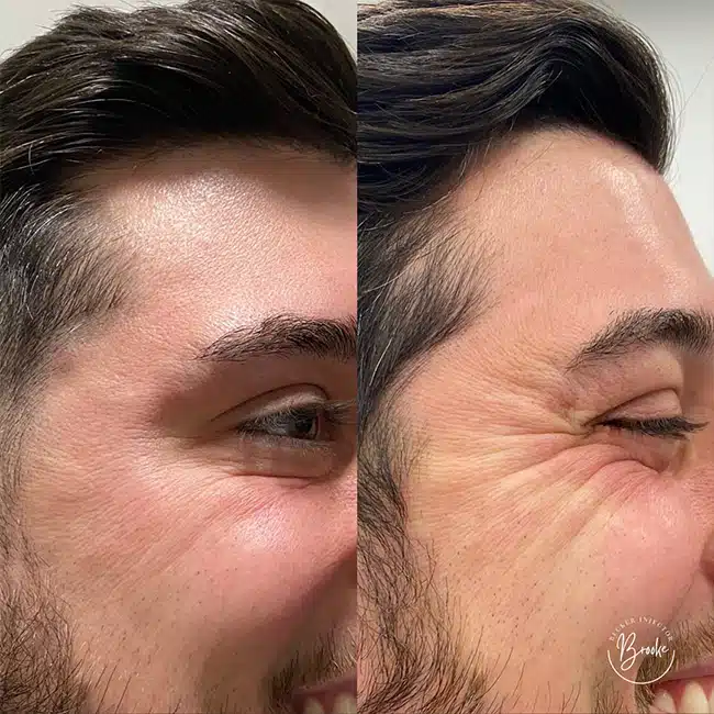 Before & After Photos Brooke Carrero, RN