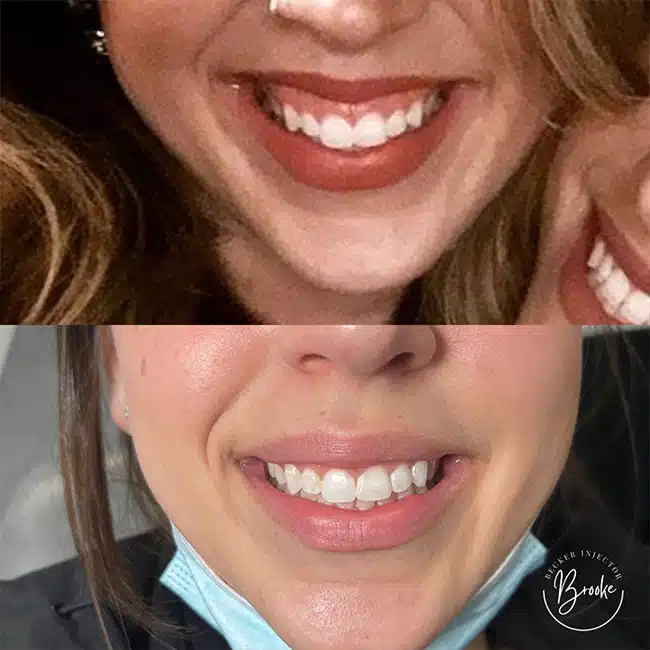 Before & After Photos Brooke Carrero, RN