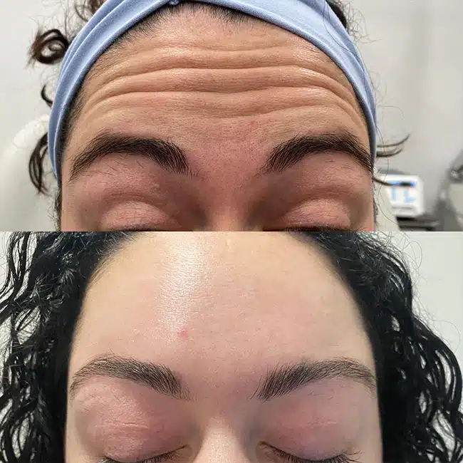 Before & After Photos Brooke Carrero, RN