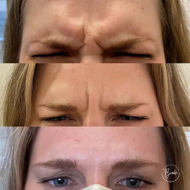 Before & After Photos Brooke Carrero, RN