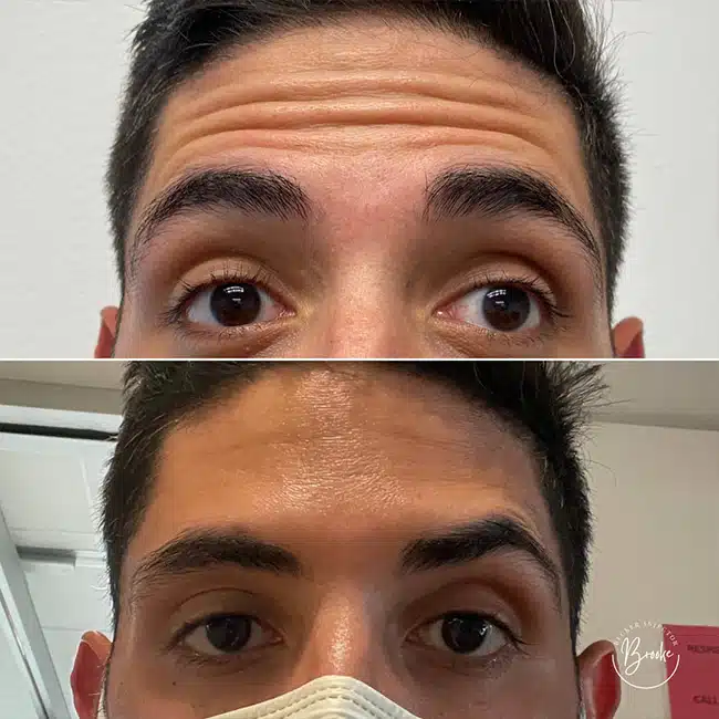 Before & After Photos Brooke Carrero, RN