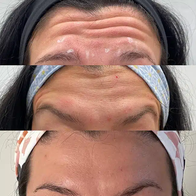 Before & After Photos Brooke Carrero, RN