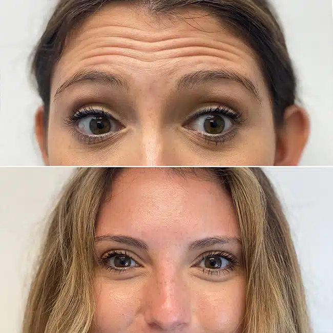 Before & After Photos Brooke Carrero, RN