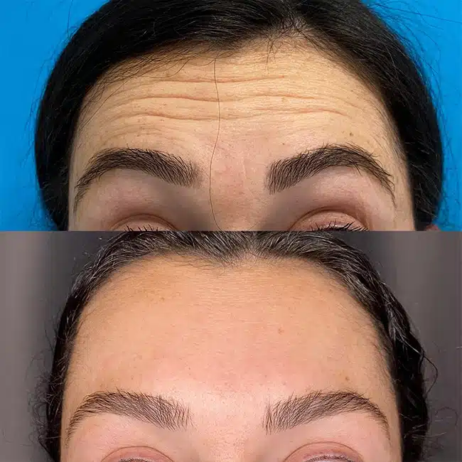 Before & After Photos Brooke Carrero, RN