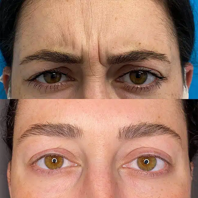 Before & After Photos Brooke Carrero, RN