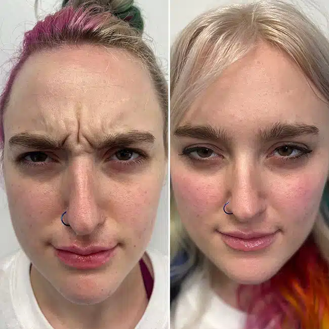 Before & After Photos Brooke Carrero, RN