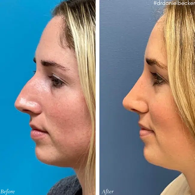 Before & After photos Dr. Becker