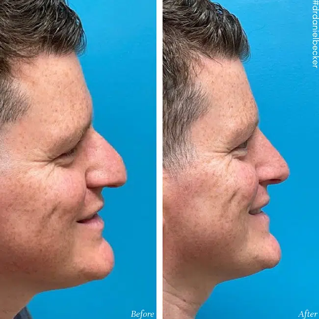 Before & After photos Dr. Becker