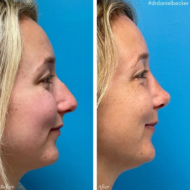 Before & After photos Dr. Becker