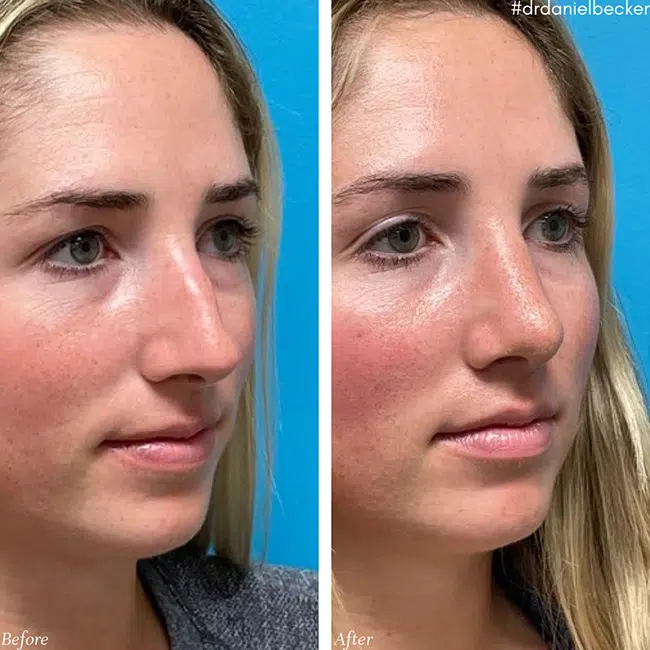 Before & After photos Dr. Becker