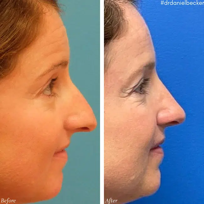 Before & After photos Dr. Becker