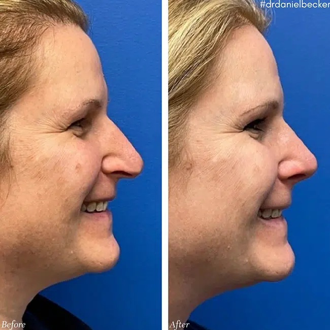 Before & After photos Dr. Becker
