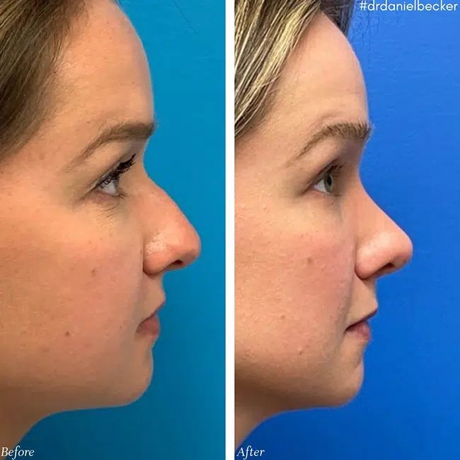 Before & After photos Dr. Becker