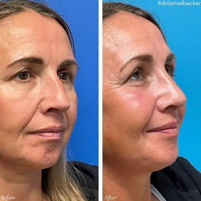Before & After photos Dr. Becker
