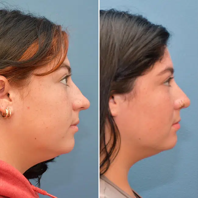 Before & After Photos Joanna Kam, MD