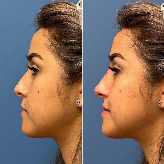 Before & After Photos Joanna Kam, MD