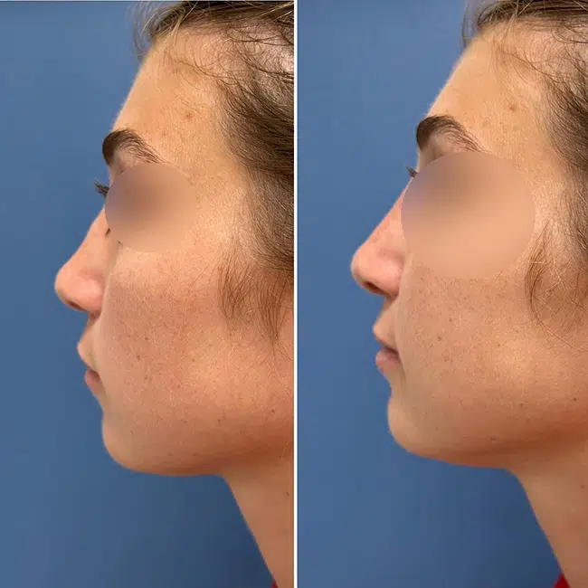 Before & After Photos Joanna Kam, MD