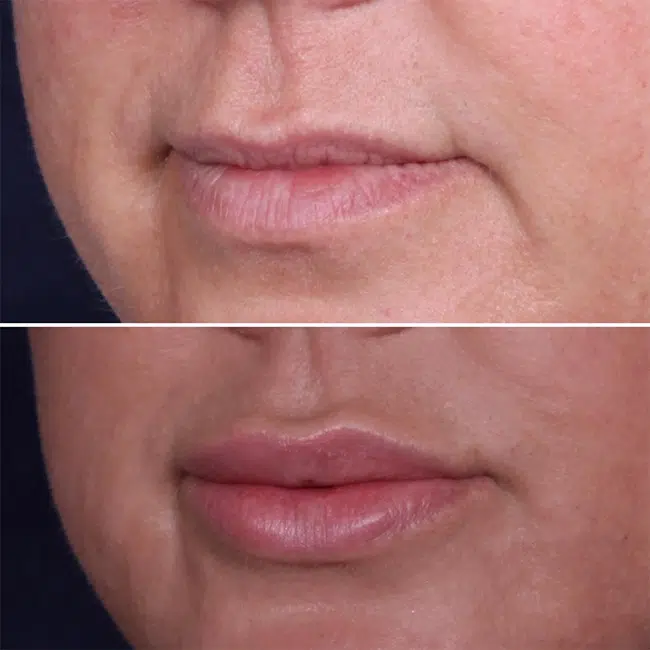 Before & After Photos Joanna Kam, MD