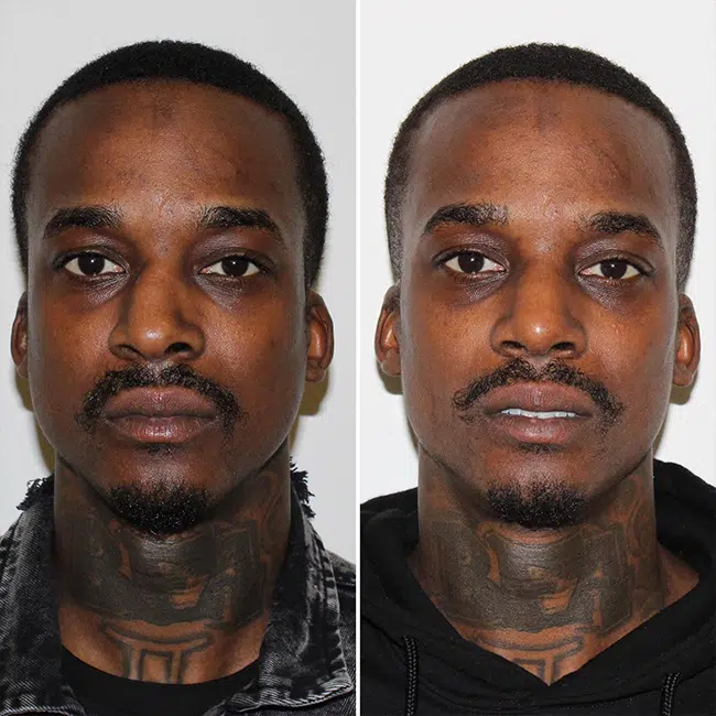 Before & After Photos Joanna Kam, MD