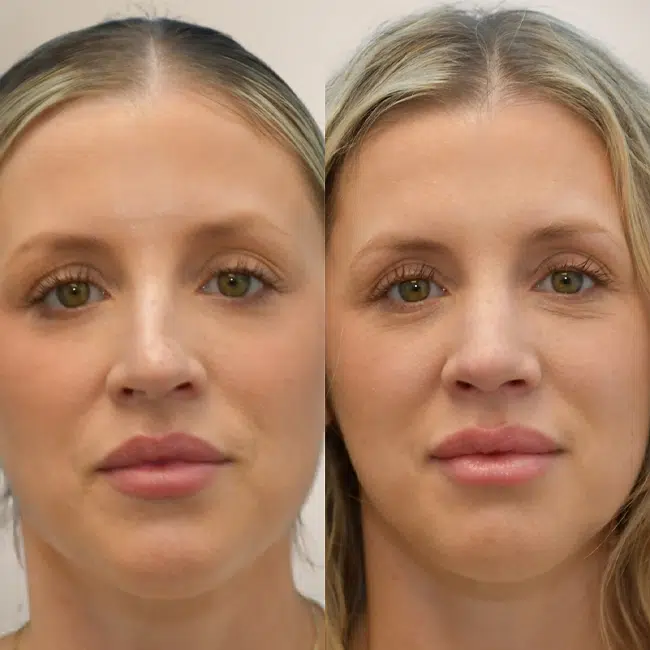 Before & After Photos Joanna Kam, MD