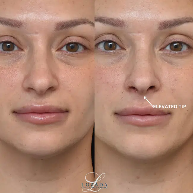 Before & After Photos Kirk Lozada, MD