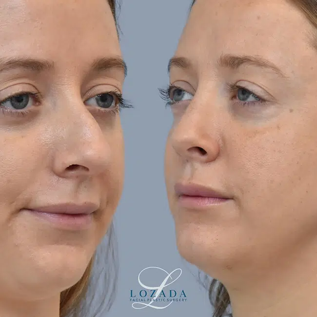 Before & After Photos Kirk Lozada, MD