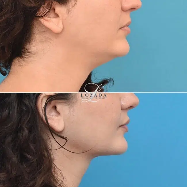 Before & After Photos Kirk Lozada, MD