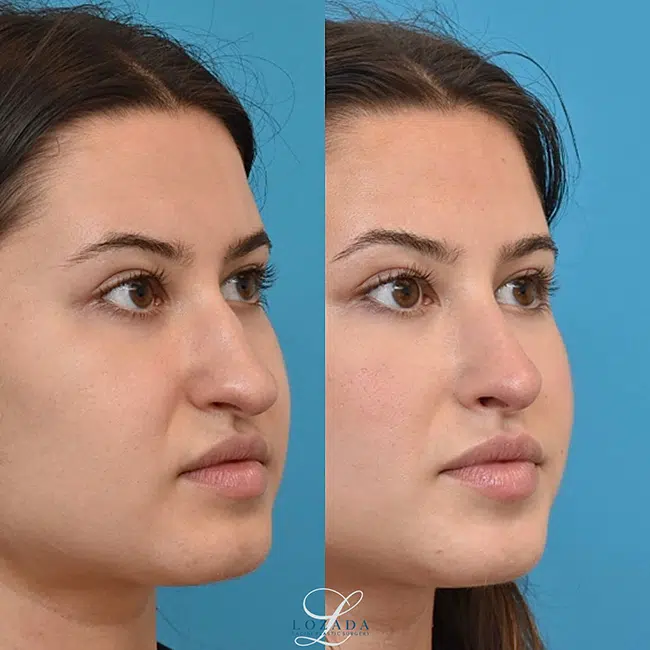 Before & After Photos Kirk Lozada, MD