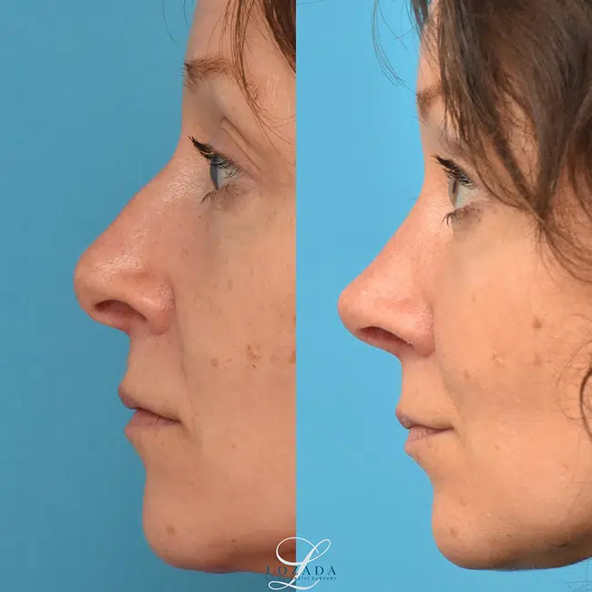 Before & After Photos Kirk Lozada, MD