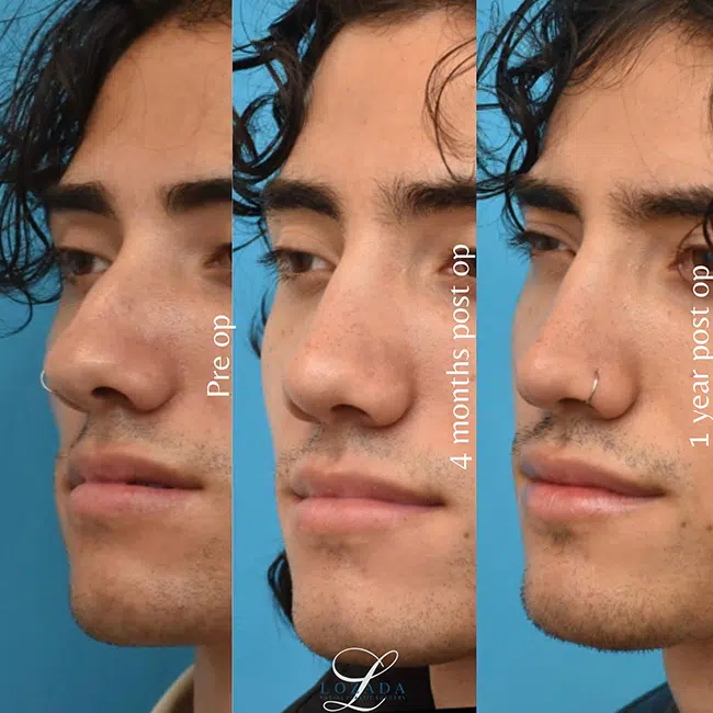 Before & After Photos Kirk Lozada, MD