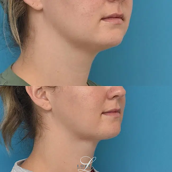 Before & After Photos Kirk Lozada, MD