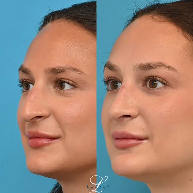 Before & After Photos Kirk Lozada, MD