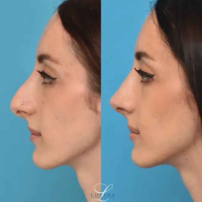 Before & After Photos Kirk Lozada, MD