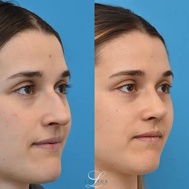 Before & After Photos Kirk Lozada, MD