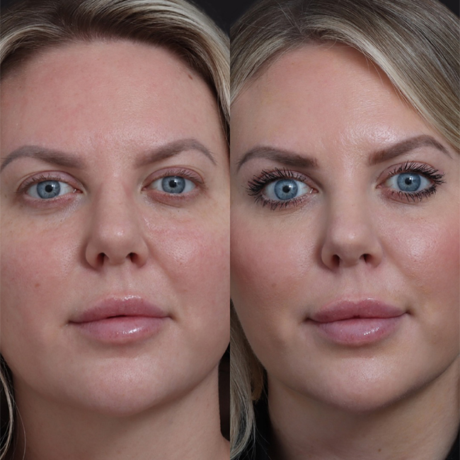 Before & After Photos Nicole Schrader, MD, FACS