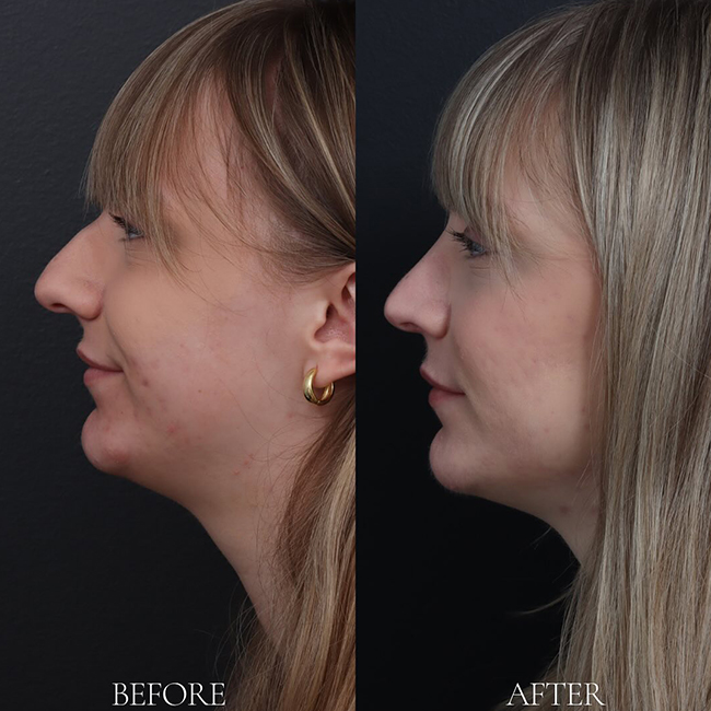 Before & After Photos Nicole Schrader, MD, FACS