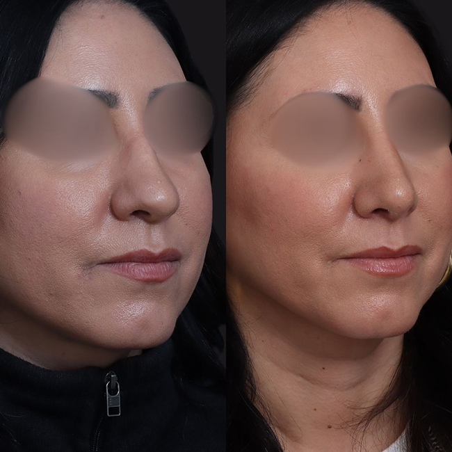 Before & After Photos Nicole Schrader, MD, FACS