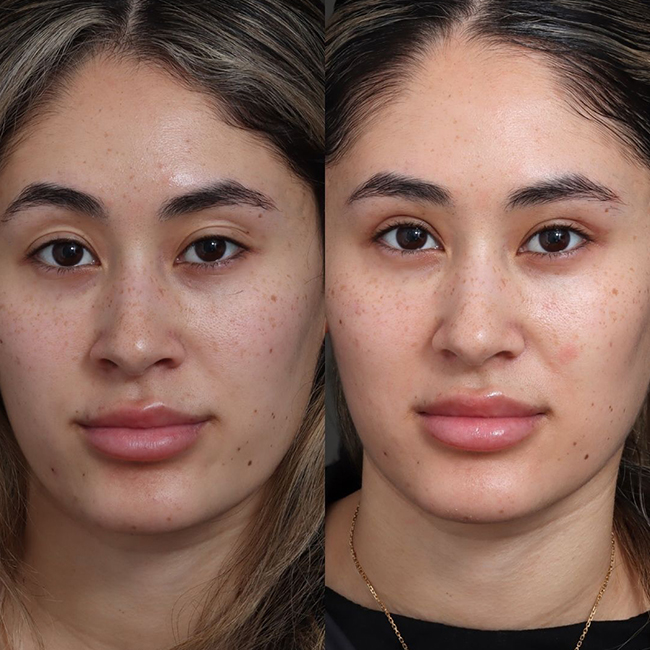 Before & After Photos Nicole Schrader, MD, FACS