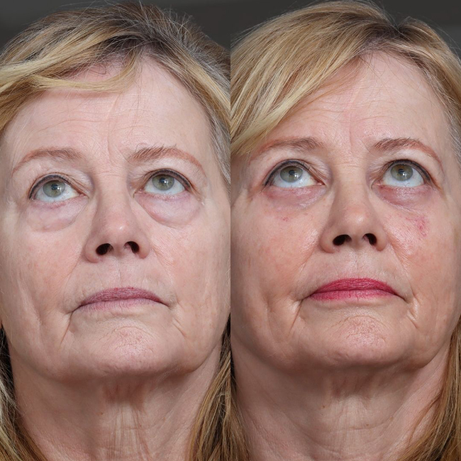 Before & After Photos Nicole Schrader, MD, FACS