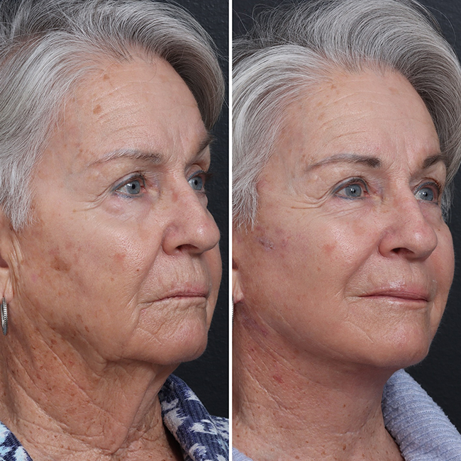 Before & After Photos Nicole Schrader, MD, FACS