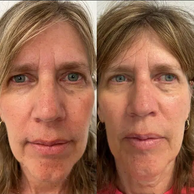 Before & After Photos Alisa Yamasaki, MD