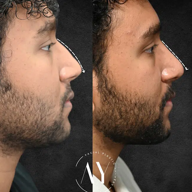 Before & After Photos Alisa Yamasaki, MD